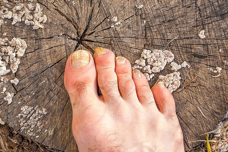 Toenail Fungus New Hope Podiatry Group Los Angeles