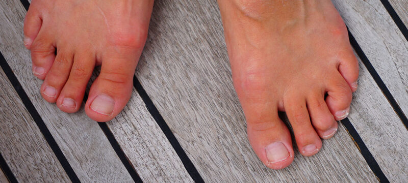 Hammer Toes New Hope Podiatry Group Los Angeles