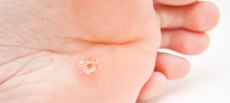 Warts New Hope Podiatry Group Los Angeles